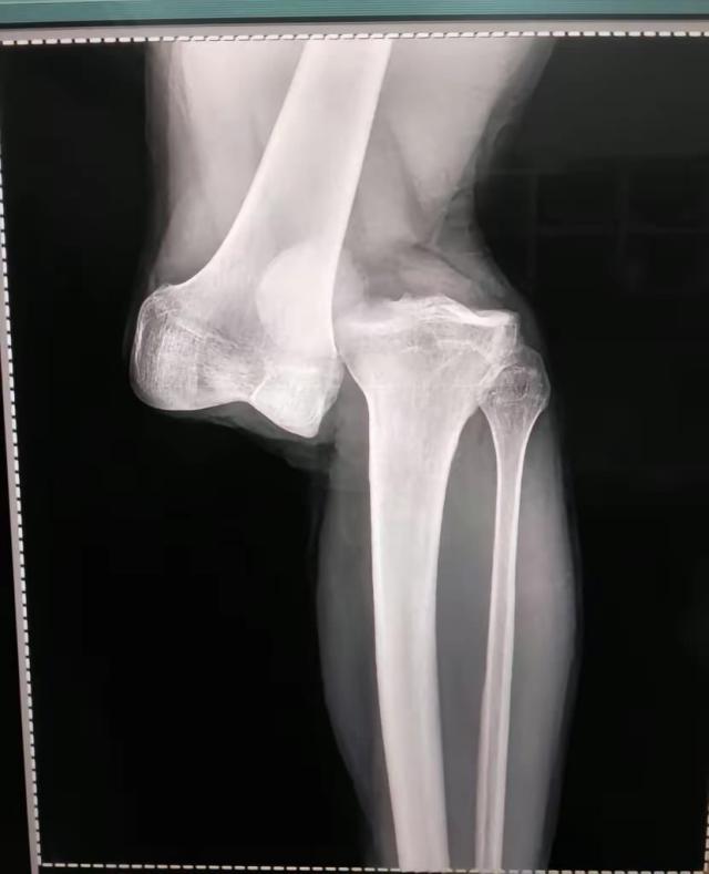 v体育-对手膝盖被踩脱臼得休1年 马塞洛为何还赢得尊重？